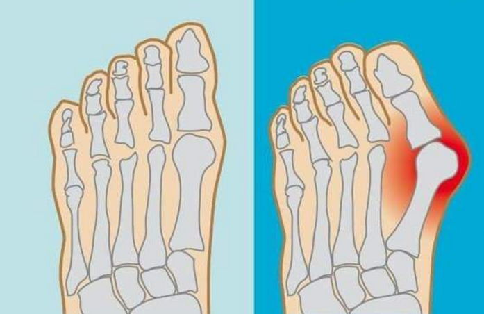DR.KONG HAV SPLINT BUNION ACCESSORIES DK-DKA11
