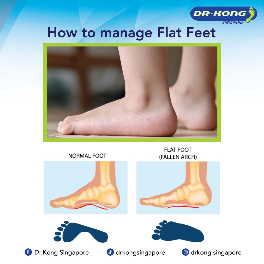 Flat Feet