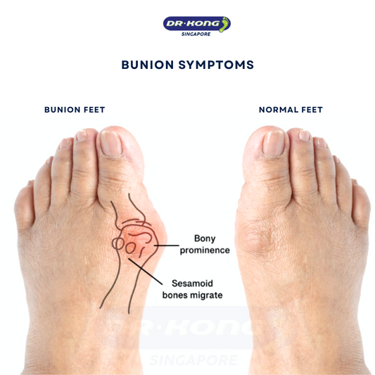 Say Goodbye to Foot Pain Bunion Solutions by Dr. Kong